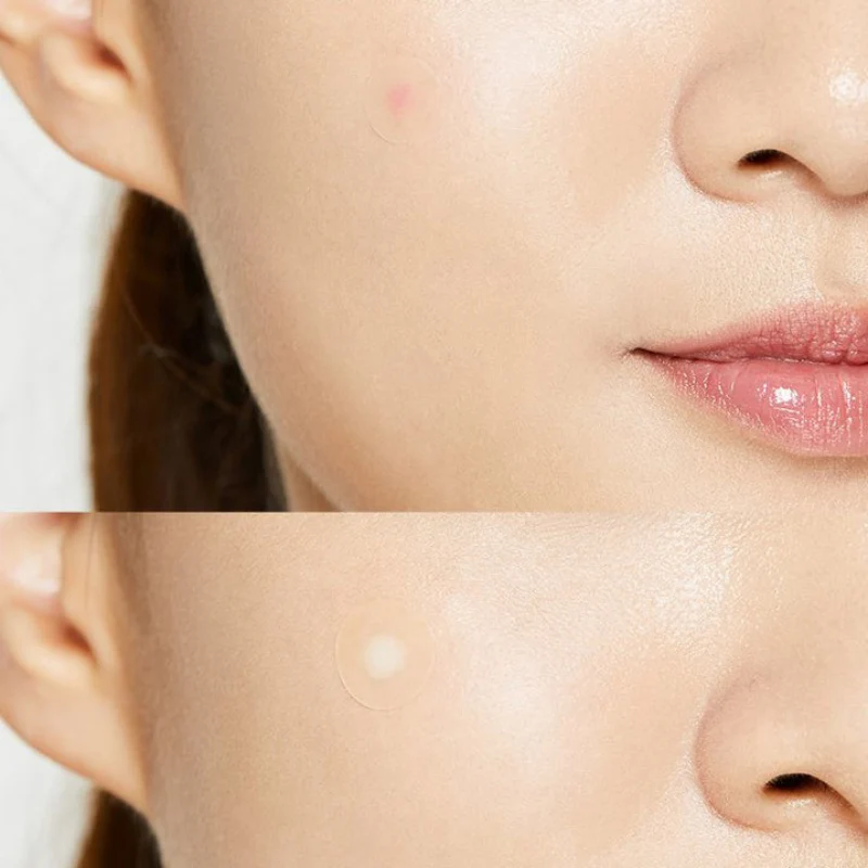 Acne Pimple Master Patches - Image 6